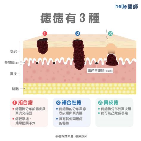 臉部痣|痣形成的原因？痣長毛、痣變多變大是痣病變？5招判。